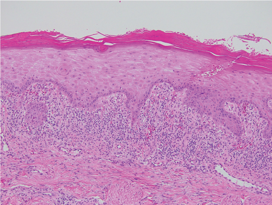 A biopsy obtained from a lichenoid plaque on the right thigh showed lichenoid interface dermatitis, minimal parakeratosis, and sawtoothed rete ridges (H&E, original magnification ×40).