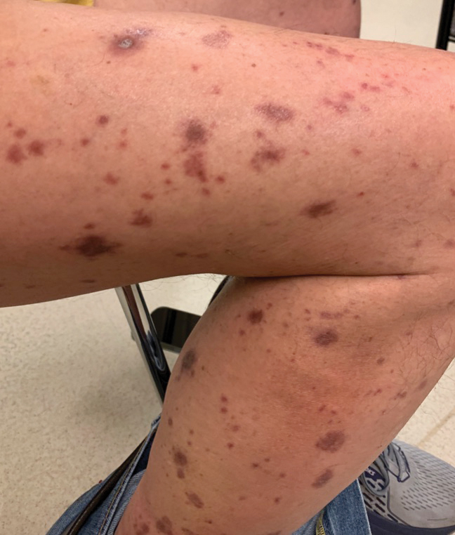Right leg with violaceous papules and plaques without erosions or ulcerations after 6 weeks of treatment consisting of cessation of immunotherapy and initiation of a systemic corticosteroid taper, acitretin, and narrowband UVB therapy.