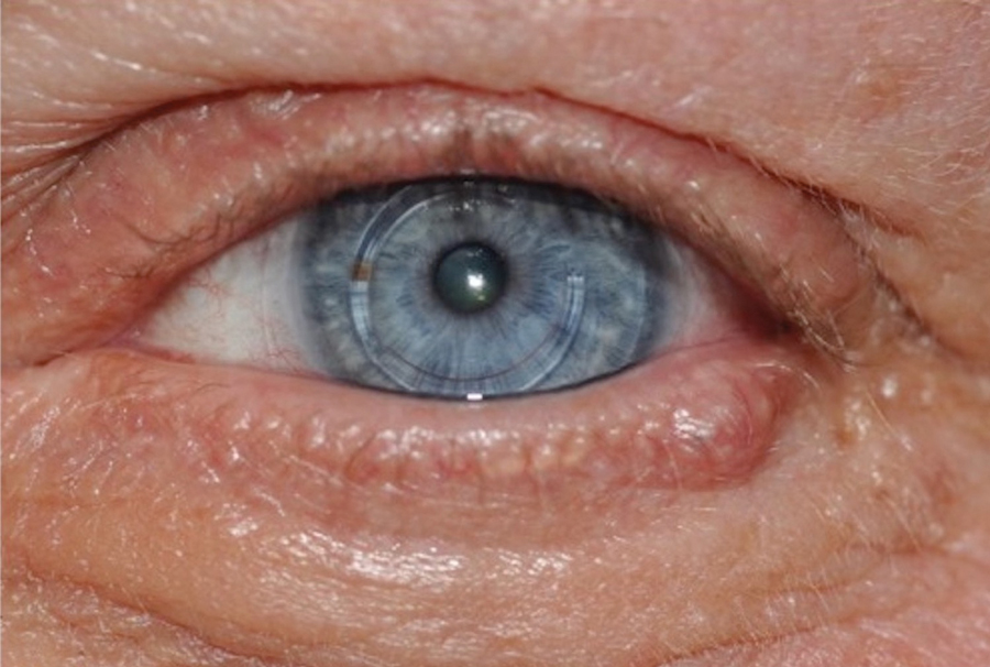 A flesh-colored papule on the left lower eyelid margin diagnosed as an endocrine mucin-producing sweat gland carcinoma (case 2).