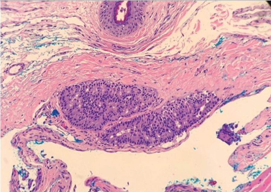 Histopathology revealed a well-circumscribed papillary nodule without apparent mucin in the dermis, consistent with an endocrine mucin‐producing sweat gland carcinoma (case 2) (H&E, original magnification ×20).