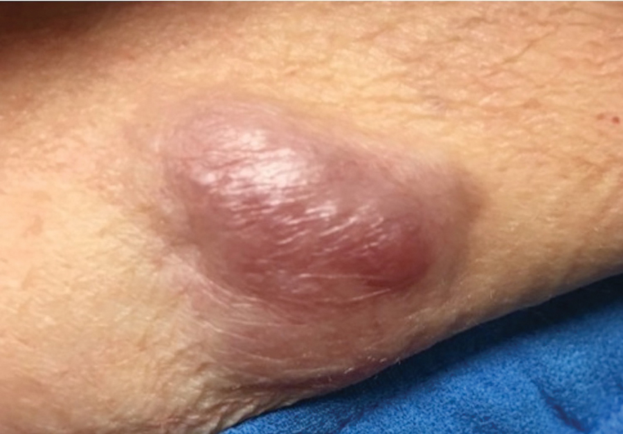 A painful pink, poorly circumscribed, subcutaneous nodule on the left lower abdomen diagnosed as a primary cutaneous mucinous carcinoma (case 4).