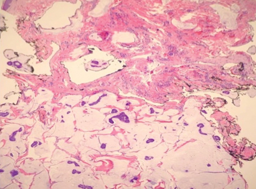 Histopathology revealed basaloid tumors infiltrating the dermis surrounded by pools of mucin, consistent with a primary cutaneous mucinous carcinoma (case 4)(H&E, original magnification ×20).