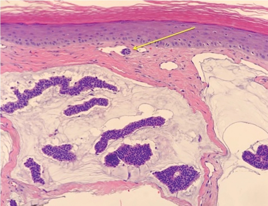 Histopathology revealed a primary cutaneous mucinous carcinoma with lymphovascular invasion (yellow arrow)(case 5) (H&E, original magnification ×20).