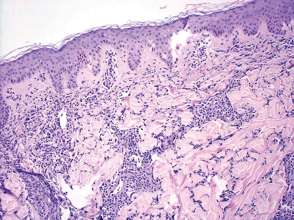 Leukemia cutis