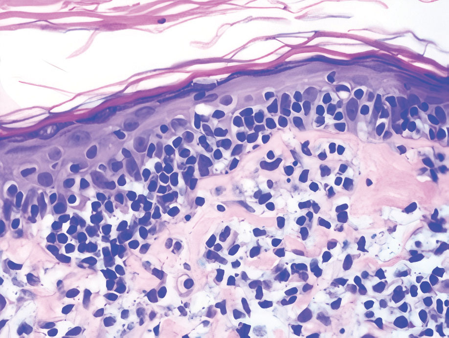 Mycosis fungoides