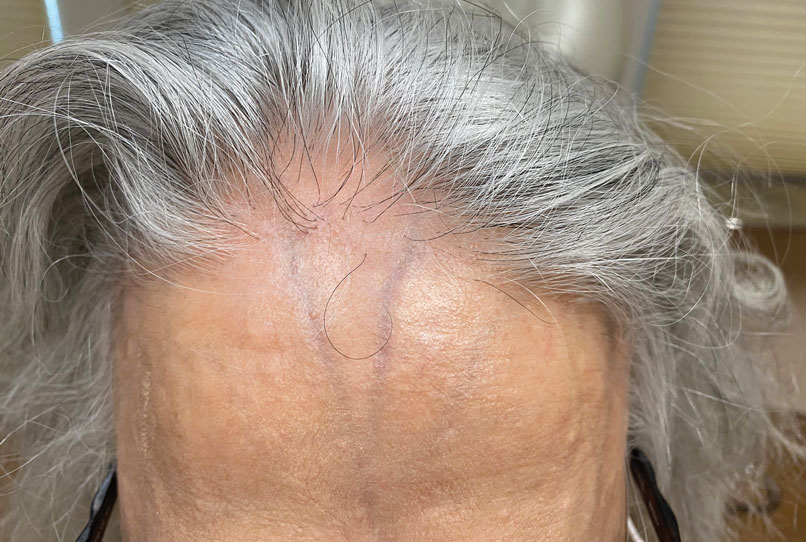 Lonely hair sign on the upper forehead in an older Middle Eastern patient with frontal fibrosing alopecia.
