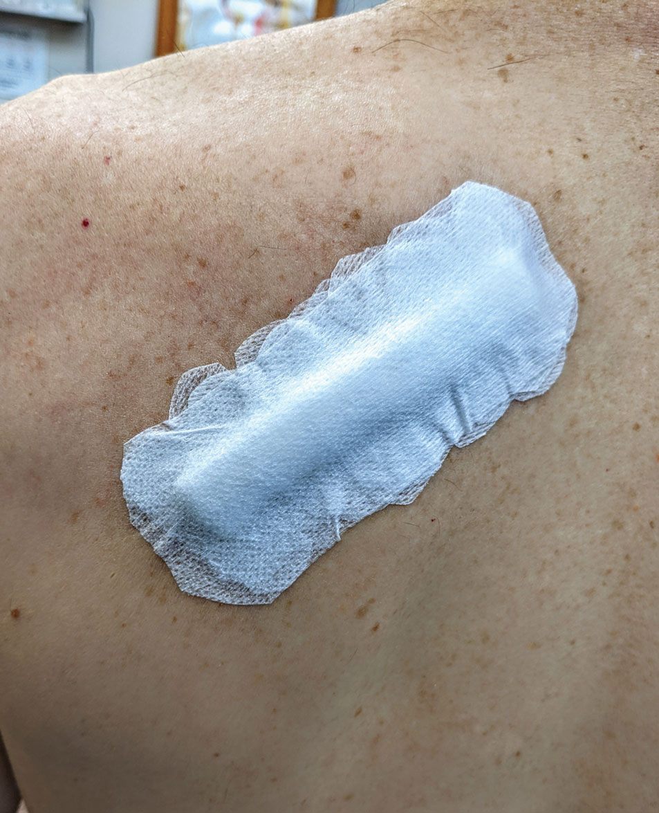 Pressure bandage on the trunk following excision and intermediate linear repair.