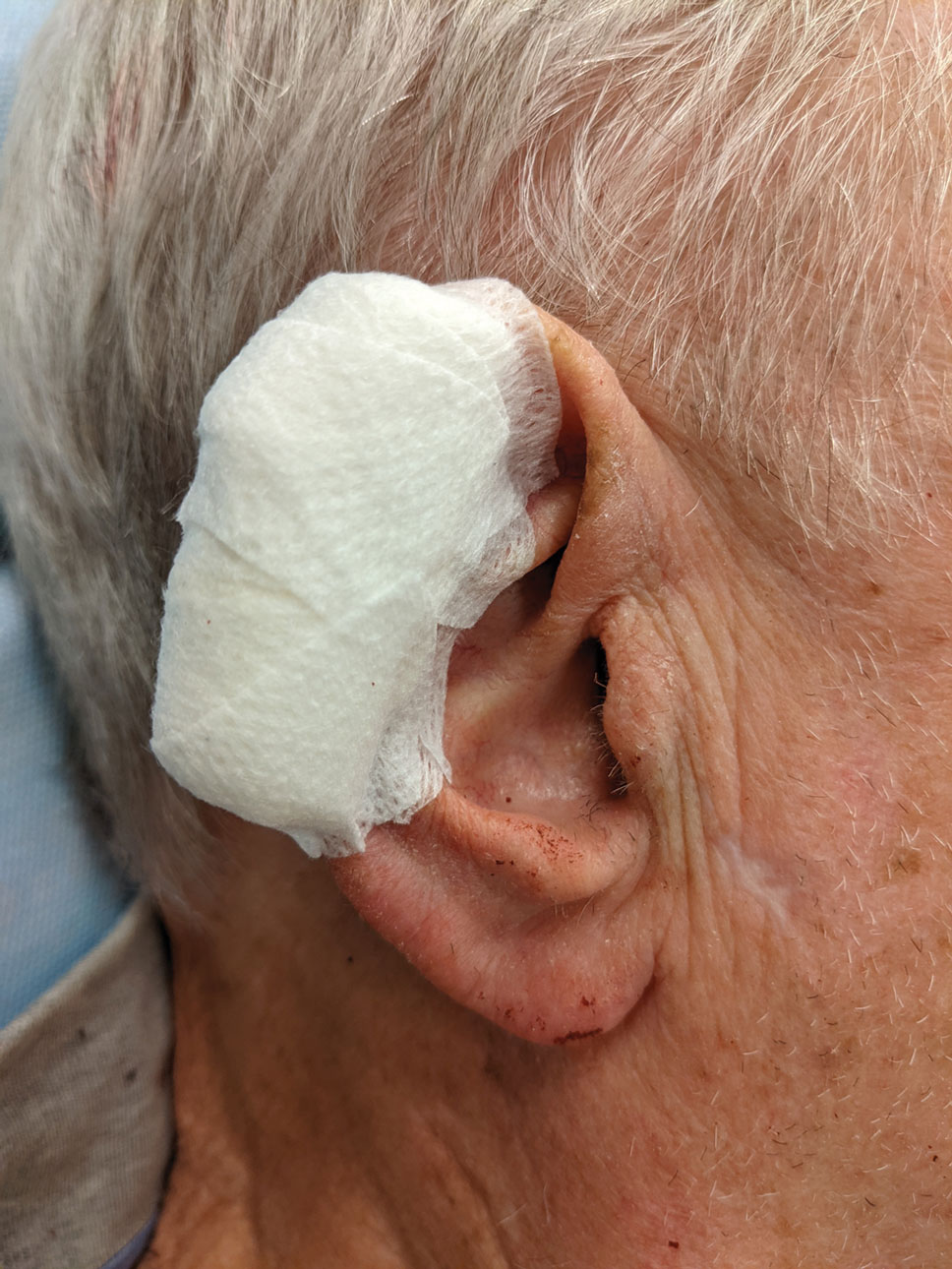 Pressure bandage on the ear, a traditionally hard-tobandage site. The elasticity of the tape conforms to the helical rim.