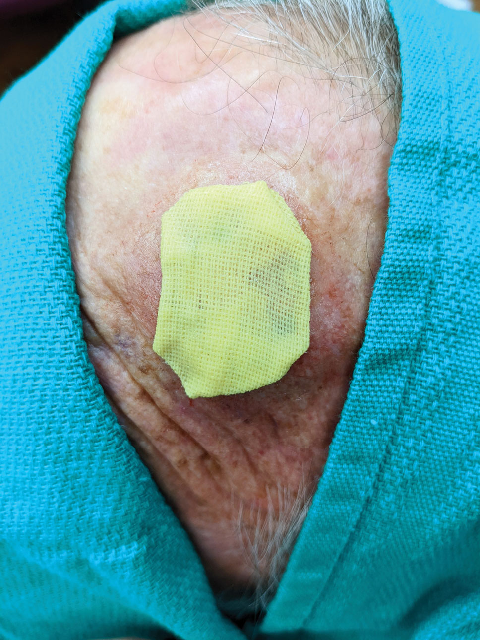 Petrolatum and bismuth tribromophenate gauze folded to size and placed over a wound that will heal by secondary intention.