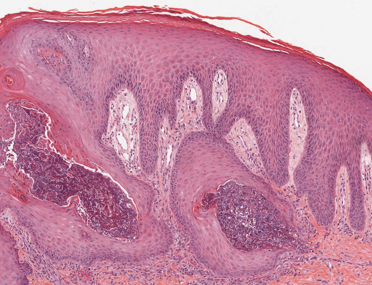 Elastosis perforans serpiginosa