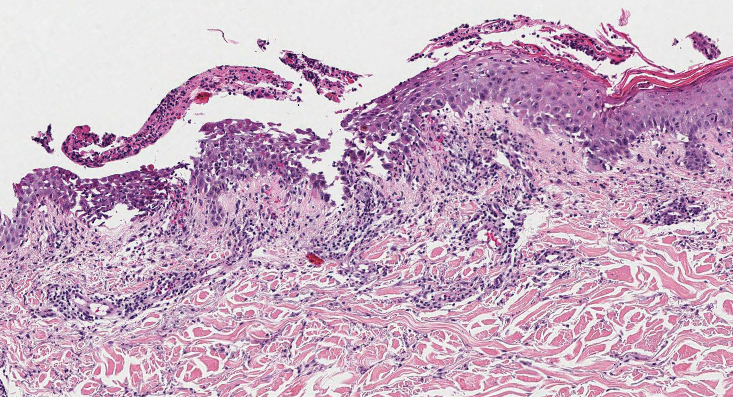 Ecthyma