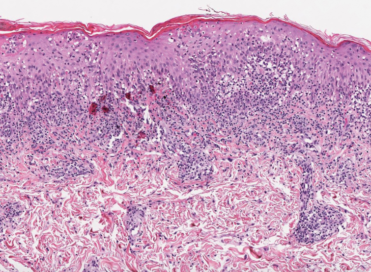 Pityriasis lichenoides et varioliformis acuta