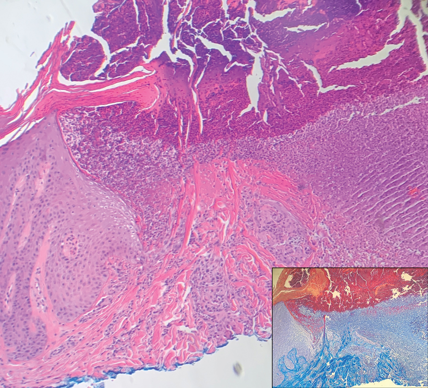 H&E, original magnification ×100; inset: trichrome, original magnification ×100.