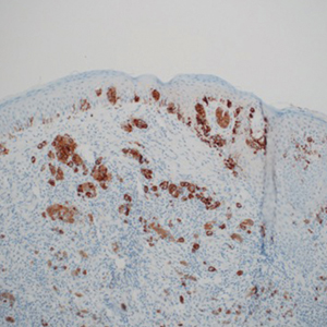 Diffuse positive (>50% of tumor cells) cytoplasmic staining of melanoma melanocytes