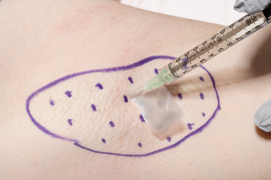 Demonstration of botulinum toxin injection technique for axillary hyperhidrosis, with adhesive tape as a barrier at a 2- to 3-mm injection depth.