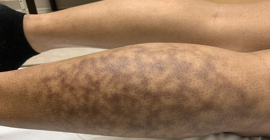 Biopsy-proven erythema ab igne in a patient with darker skin.