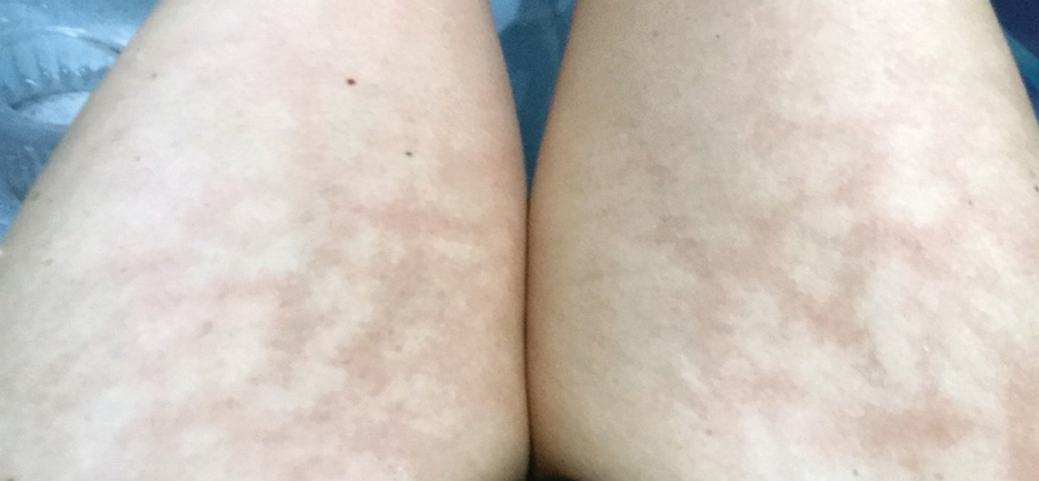 Livedo reticularis in a patient with chronic autoimmune disease.