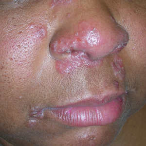 Pink, elevated, granulomatous, indurated plaques on the face