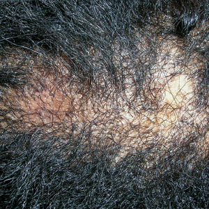 Central centrifugal cicatricial alopecia