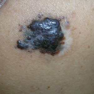 Melanoma