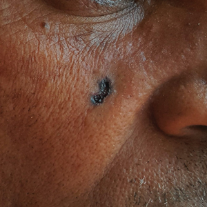 Nodular BCC on the cheek of a 64-year-old Black man