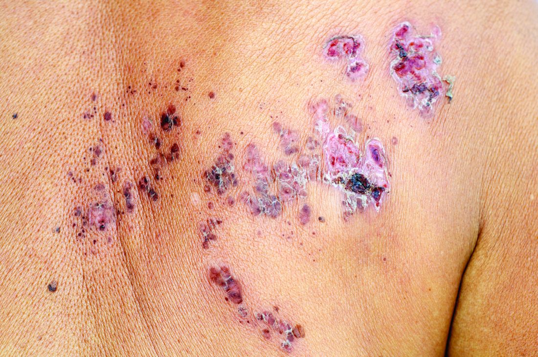 Herpes zoster risk increased with some psoriasis ...
