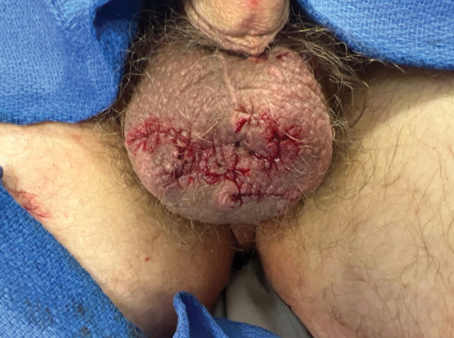 Surgical repair of the scrotum immediately (same day) following the removal of scrotal calcinosis nodules.