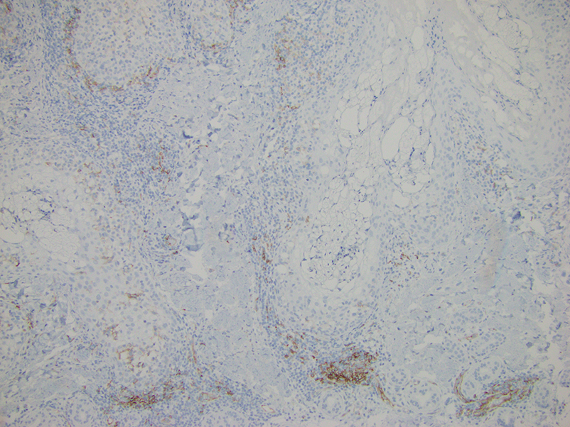 Colloidal iron staining demonstrated focal dermal mucin deposition