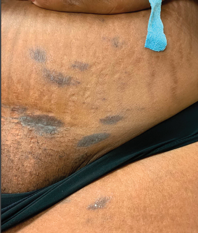 Asymptomatic Discolored Lesions on the Groin