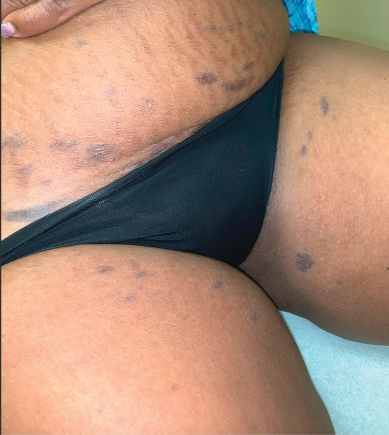 Asymptomatic Discolored Lesions on the Groin