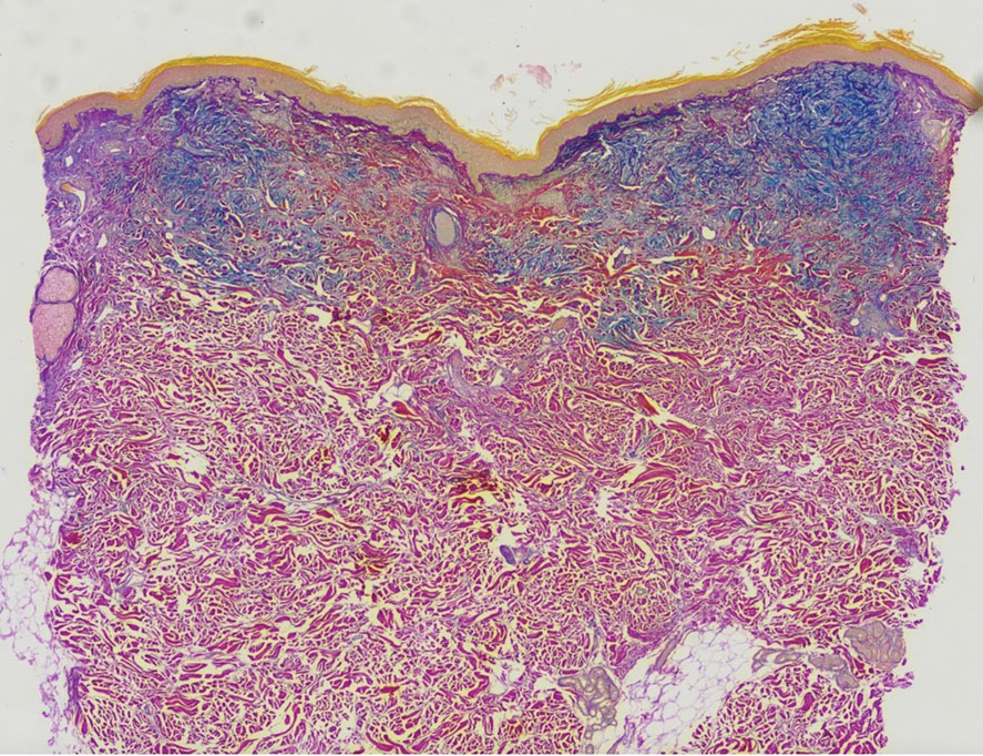 Colloidal iron staining showed increased mucopolysaccharides in the papillary dermis (original magnification ×10).