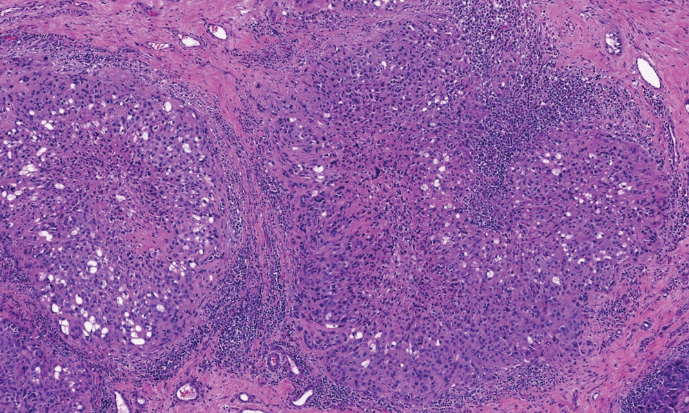 Epithelioid sarcoma. Nodular pattern with central necrosis and dense hyalinized collagen deposits surrounded by a palisading inflammatory infiltrate