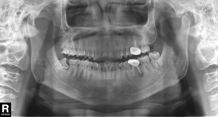 Panoramic radiography showed a radiolucency in the periapex of the mandibular first molar,