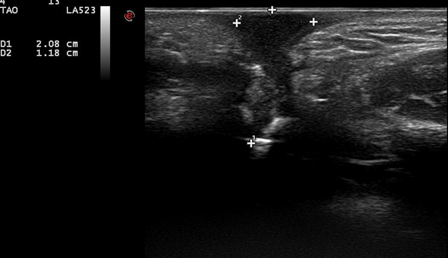 Ultrasonography depicted a hypoechoic band that originated from the cutaneous lesion and extended through the subcutaneous tissue to the defective alveolar bone.