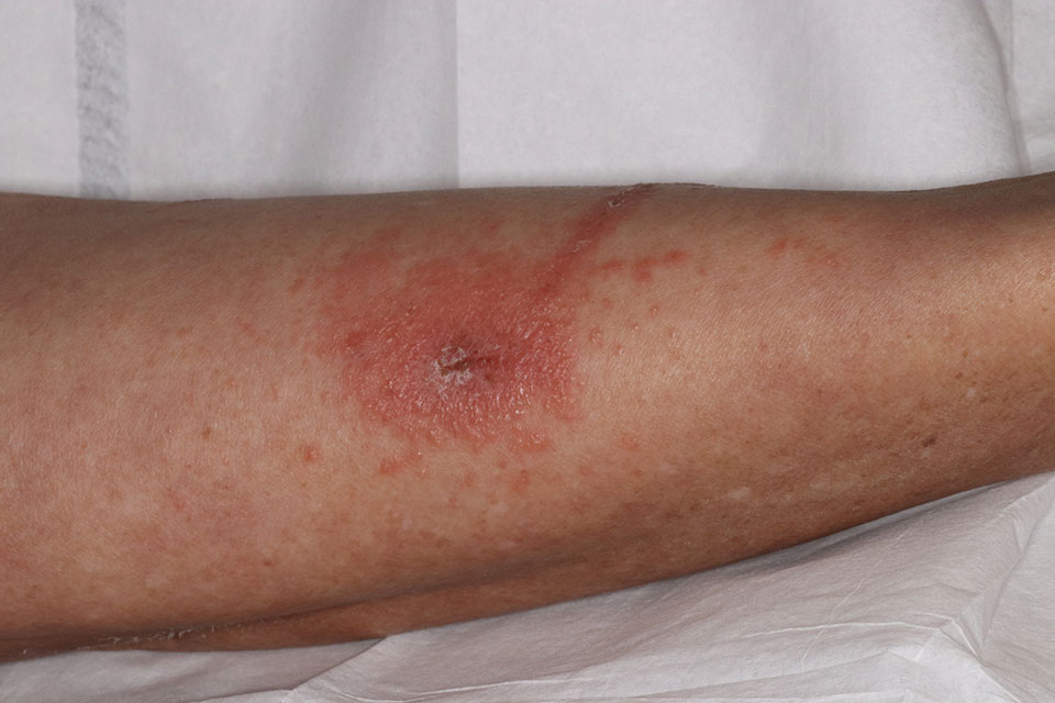Erythematous vesicular rash with secondary crusting in a patient with Toxicodendron dermatitis.