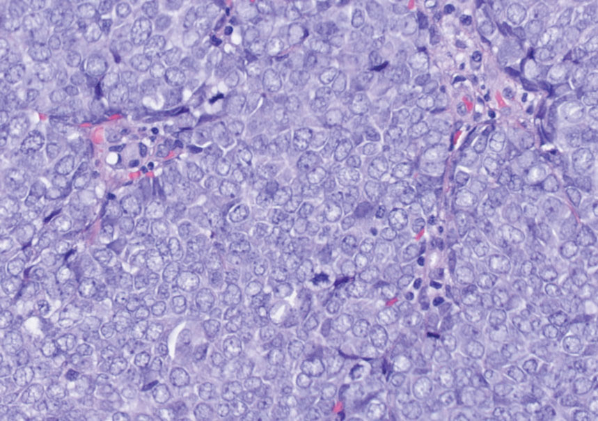 Merkel cell carcinoma. Small, round, blue tumor with oval nuclei, salt-and-pepper chromatin, high mitotic index, and indistinct nucleoli (H&E, original magnification ×400).