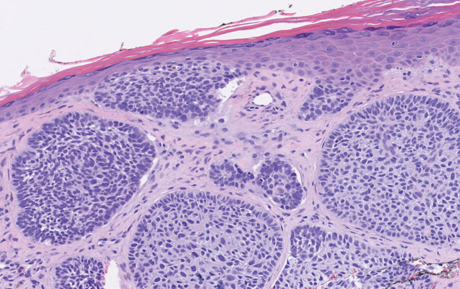 Basal cell carcinoma. Basaloid budding, connection with the epidermis, mucinous stroma, retraction artifact, and palisading blue cells in a picket fence–like distribution around the periphery (H&E, original magnification ×210).