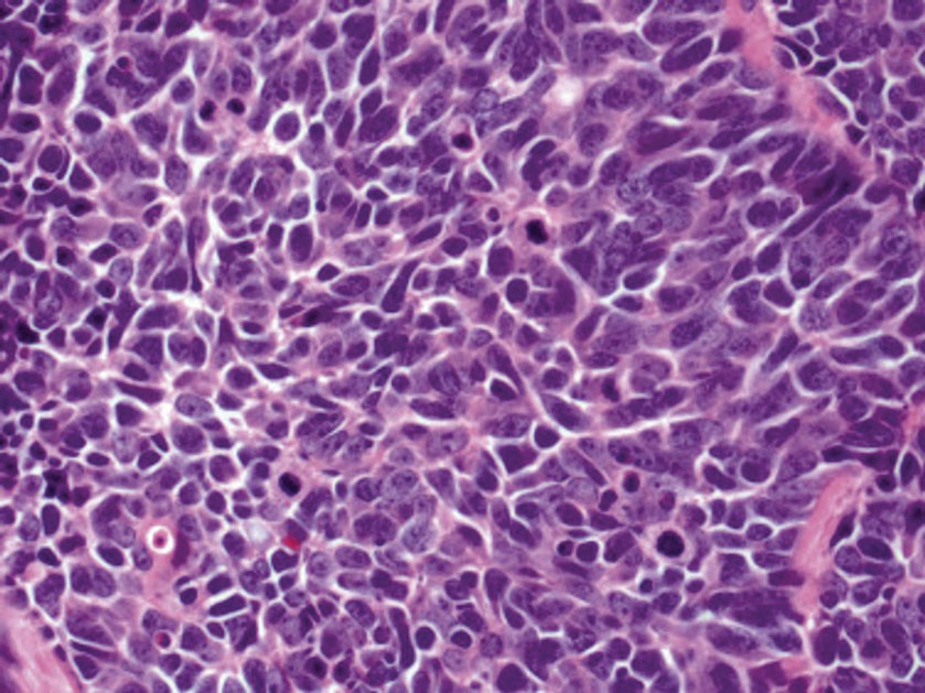 Small cell lung carcinoma. Round blue cells with minimal cytoplasm, nuclei with finely dispersed chromatin, indistinct nuclei, and a high mitotic rate. The stroma is thin and delicate, and apoptosis of individual cells commonly is seen (H&E, original magn