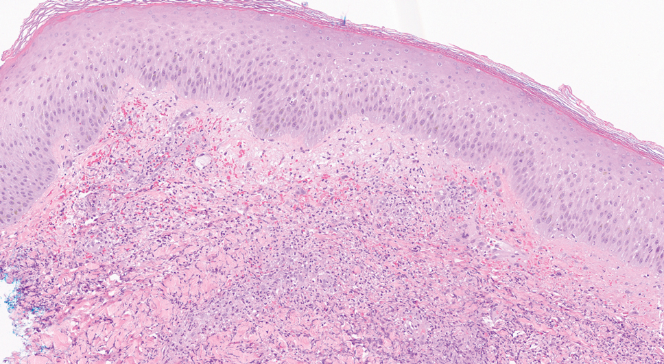 Medium-power view demonstrated a dermal neutrophilic infiltrate with extravasated erythrocytes (H&E, original magnification ×20).