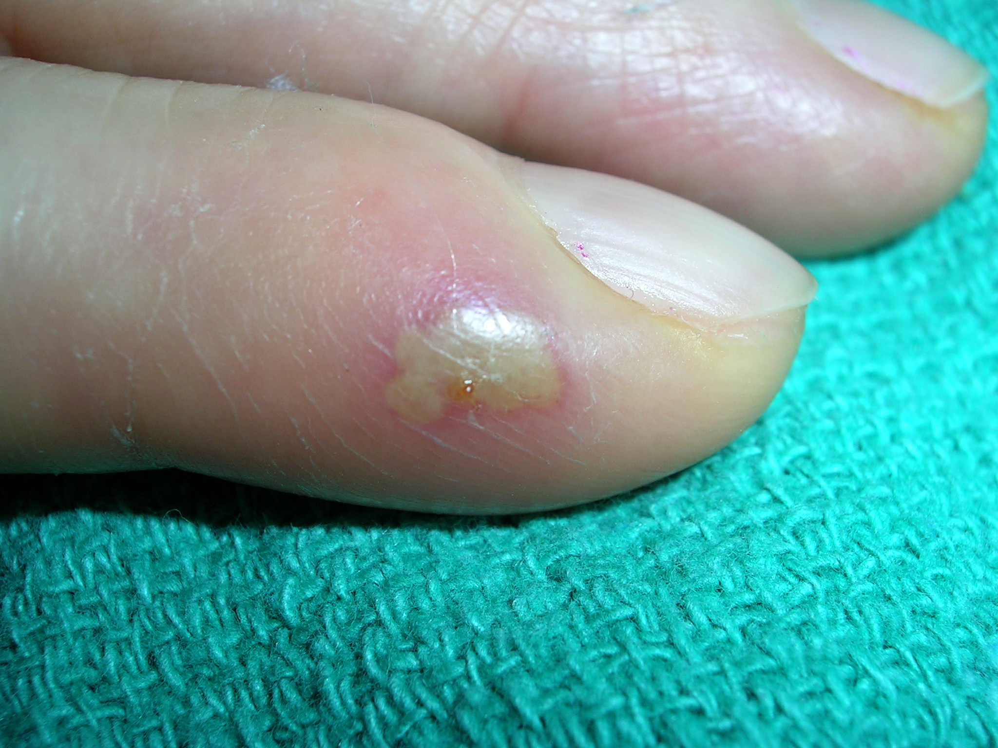 Will A Finger Infection Heal On Its Own