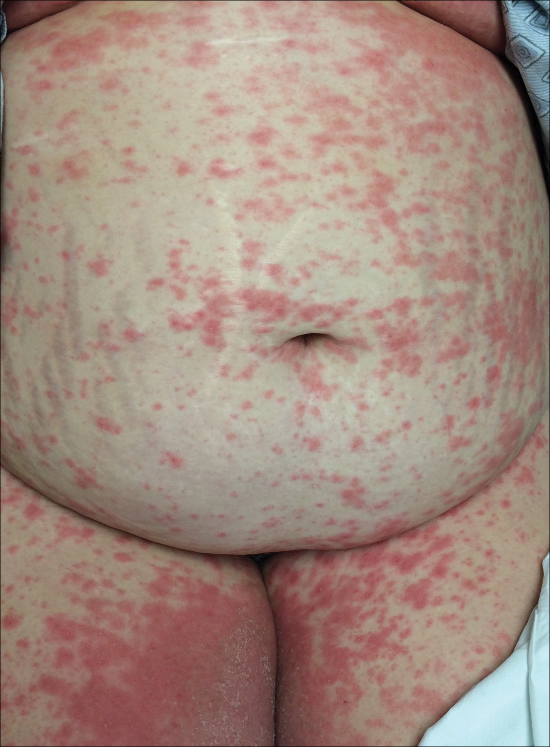 developed psoriasis during pregnancy)