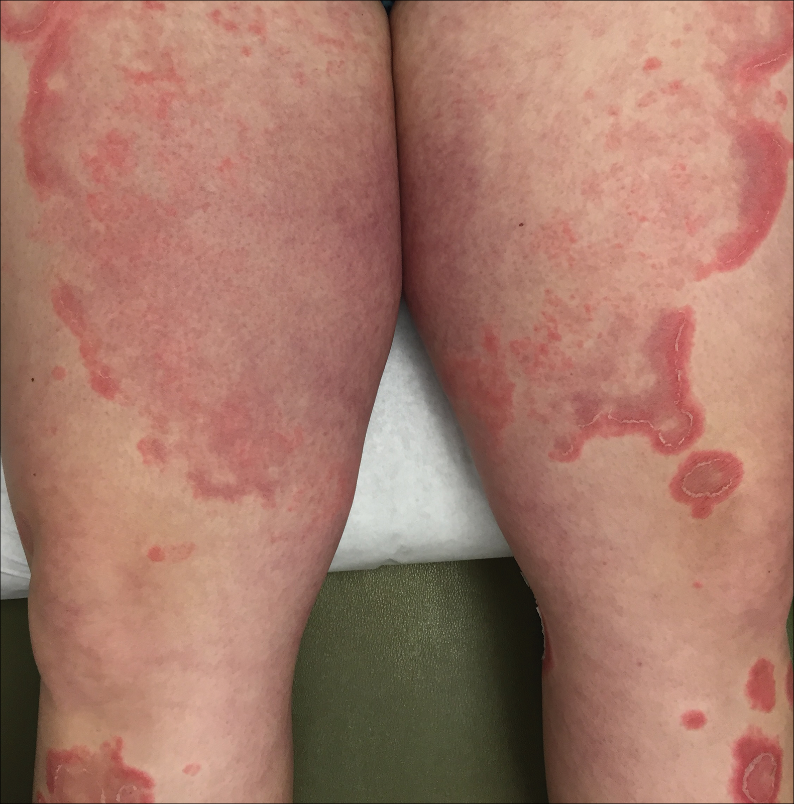 pustular psoriasis in pregnancy