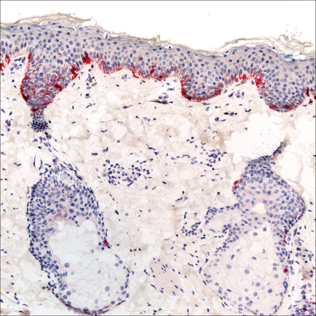 Facial Involvement In Progressive Macular Hypomelanosis MDedge