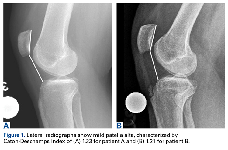 Patella Alta Sees You, Do You See It? | MDedge Surgery