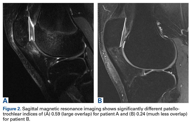 Patella Alta Sees You, Do You See It? | MDedge Surgery