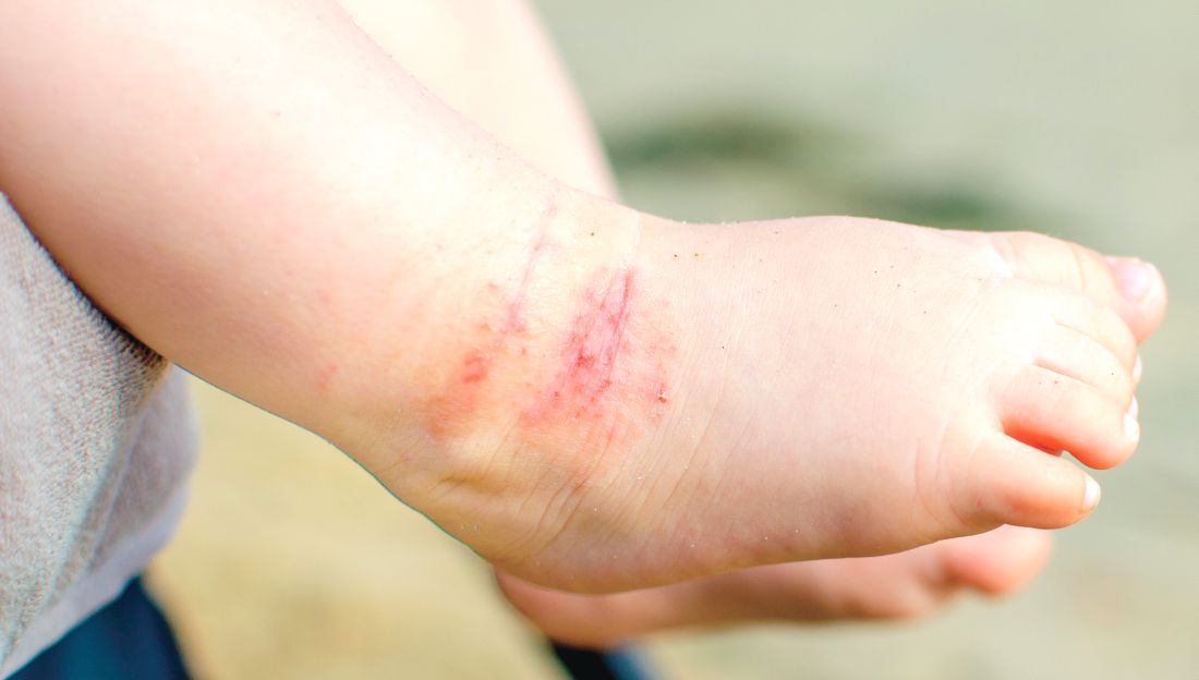 الإصابة المبكرة بالتهاب الجلد التأتبي مرتبطة بضعف السيطرة | طب الأطفال