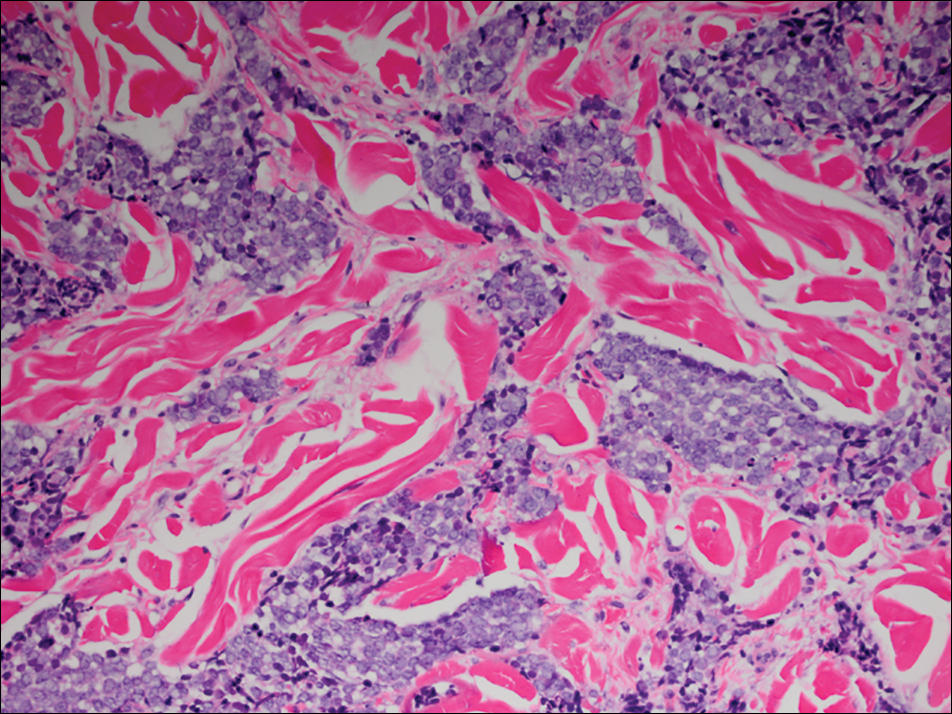 Merkel Cell Carcinoma Histology Merkel Cell Carcinoma Treatment Pdq