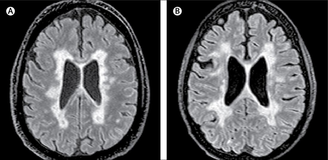 New MS subtype shows absence of cerebral white matter ...