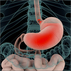 How often does long-term PPI therapy cause clinically significant hypomagnesemia?