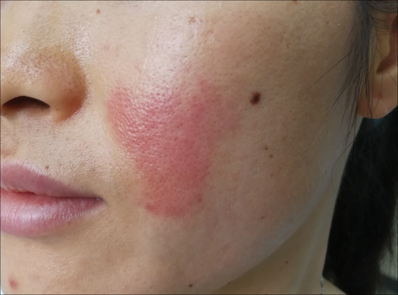 Acute Painful Rash On The Cheek Mdedge Dermatology